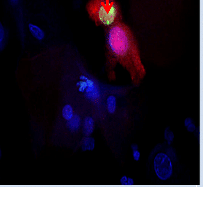 DIF p16/Ki-67 dual-stain immunofluorescence