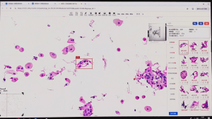 AI-powered cervical cytology screening identifies abnormal cells and improves laboratory efficiency.